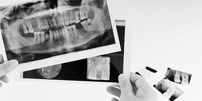 x-ray of teeth and mouth